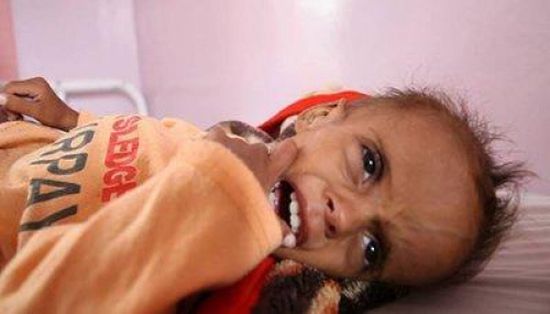  اليونسيف تنتقد شحة الجهود الإنسانية تجاه المعاناة في اليمن