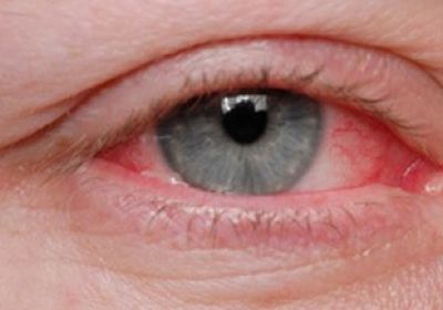 أعراض التهاب العين ونصائح لتجنبها