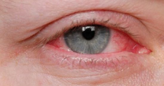 أعراض التهاب العين ونصائح لتجنبها