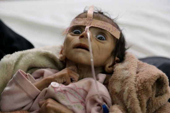 الأمم المتحدة تتهم الحوثیين بتجویع 76 % من الیمنیین 