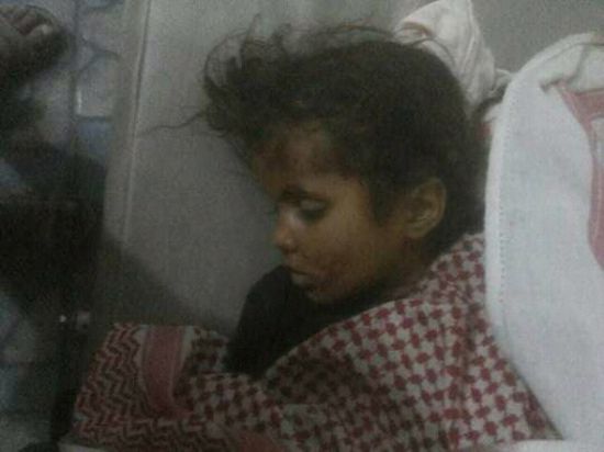  الضالع : مصرع طفلة واصابة اخرى اثر انفجار قنبلة من مخلفات الحرب 