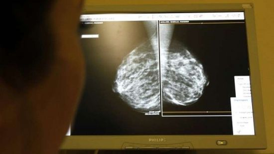 اكتشاف 24 طفرة جينية مجهولة تزيد خطر الإصابة بسرطان الثدي