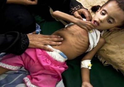 صور.. تلاعب الحوثي بالإغاثة يهدد عشرات الأطفال بالموت