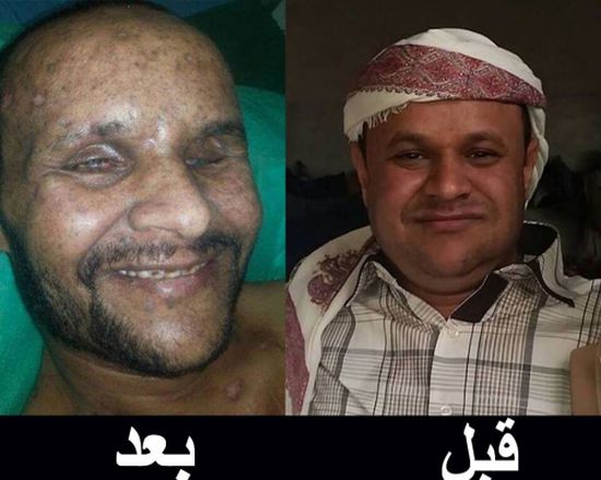 "الشطاف" معلم من ابناء الضالع اختطفه الحوثيون من جوار مدرسته بصنعاء .. تعرف على مأساته وتعرضه للقصف 