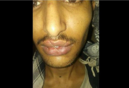 سجين يمني في إب يخيط فمه احتجاجاً على استمرار حبسه
