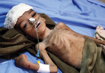 الميليشيات تشترط علاج جرحاها مقابل تطعيم اليمنيين ضد الكوليرا