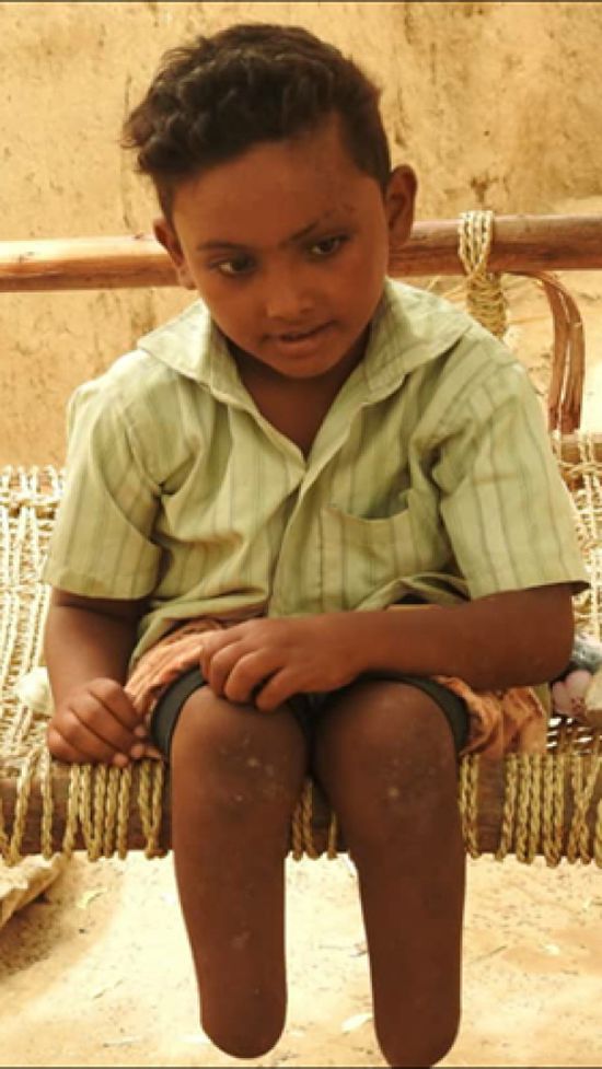بالصورة .. قصة الطفل «درهم» مأساة تروي للأجيال فضائع وبشاعات إجرام مليشيا الحوثي