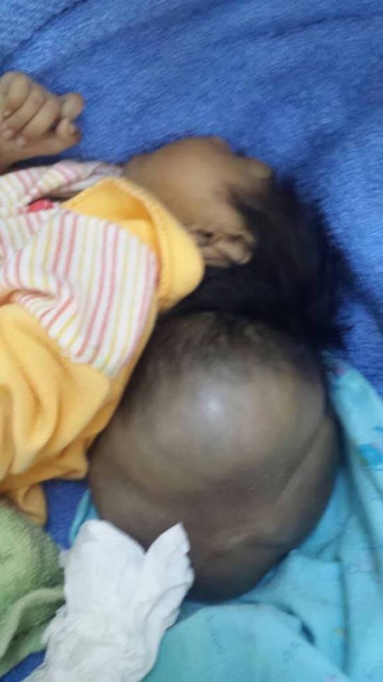 اليمنية نراعي المعايير الدولية في التعامل مع المرضى و وفاة الطفلة عائشة ناتج عن حالتها الحرجة 