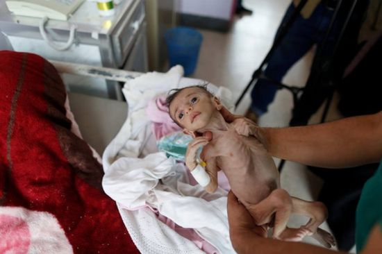 شاهد.. صور مرعبة لأطفال باليمن يعانون من سوء التغذية