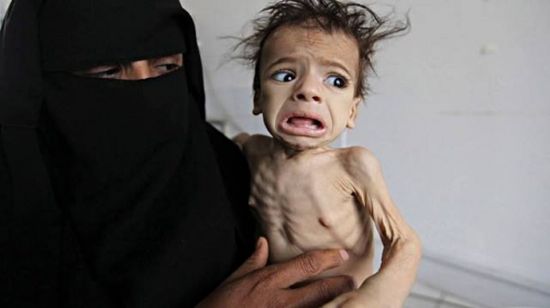 يونيسيف: أطفال اليمن بلا طعام ويتعرضون للموت