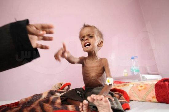 حجة: سوء التغذية  يودي بحياة طفلة 