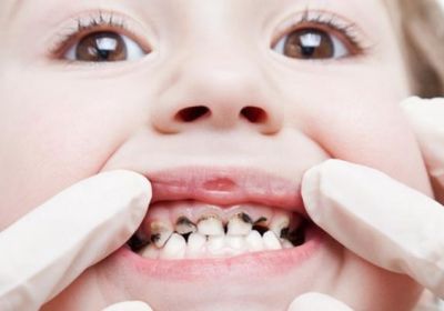 أعشاب طبيعية لعلاج آلام تسوس الأسنان اللبنية عند الأطفال