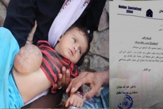 الإمارات تواصل دعمها لأطفال اليمن وتتكفل بعلاج الطفلة أسرار