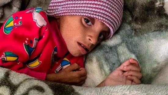  أمل حسين.. رحلة في حرب الجوع تلخص ظروف الأطفال في مناطق سيطرة الميليشيات