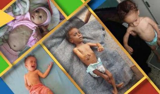 صحيفة بريطانية: "فيسبوك" يفرض رقابة على صور الأطفال الجوعى في اليمن