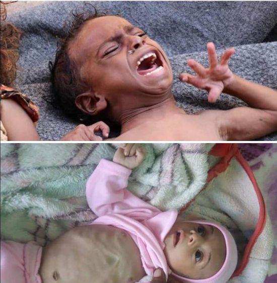 "المجاعة تجتاح المسيمر".. نشطاء يتداولون صورا لأطفال المدينة