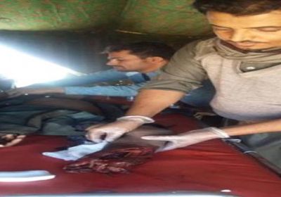 بتر ساق طفل بانفجار لغم فردي من مخلفات الحـوثيين في البيضاء