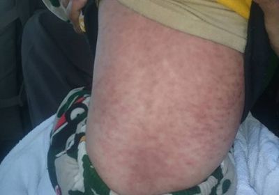 أمراض جديدة تضرب «صنعاء وعمران» وتنتشر في مناطق سيطرة الحوثيين (تفاصيل)