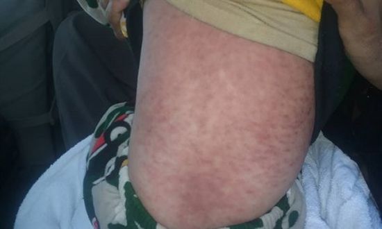 أمراض جديدة تضرب «صنعاء وعمران» وتنتشر في مناطق سيطرة الحوثيين (تفاصيل)