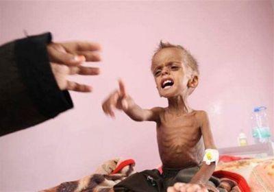 إنشاء قسم طبي بتعز للحد من انتشار أمراض سوء التغذية