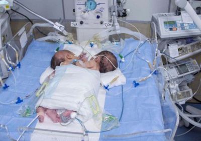 وفاة توأمين سياميين في صنعاء