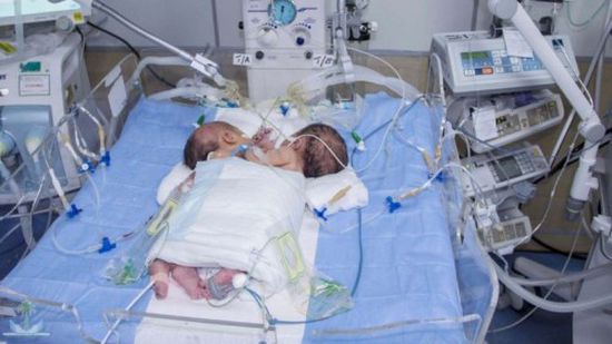 وفاة توأمين سياميين في صنعاء