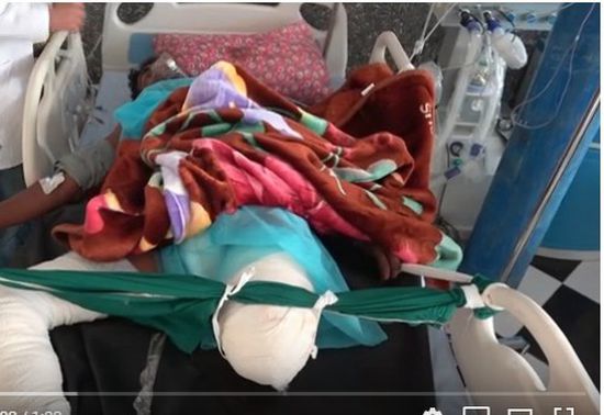إصابة مواطن بانفجار لغم حوثي في أطراف الحديدة (فيديو)