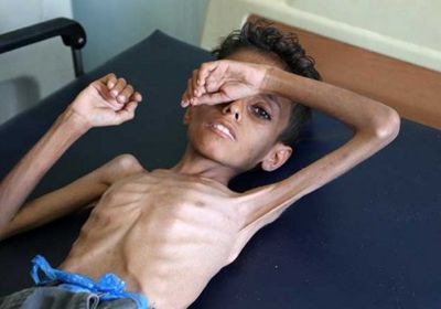 اليونيسيف تدق ناقوس الخطر.. الجوع ينهش في أطفال اليمن