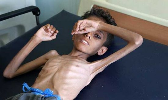 اليونيسيف تدق ناقوس الخطر.. الجوع ينهش في أطفال اليمن