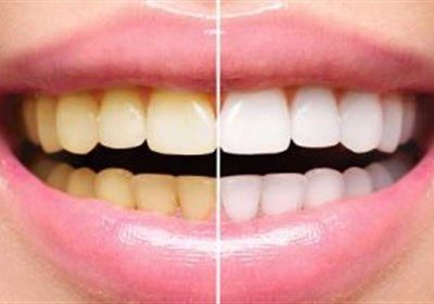 دراسة تحذر من "تبيض الأسنان"..تسبب أضرار جسيمة بسبب المواد الكيماوية