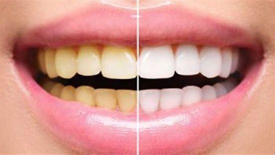 دراسة تحذر من "تبيض الأسنان"..تسبب أضرار جسيمة بسبب المواد الكيماوية