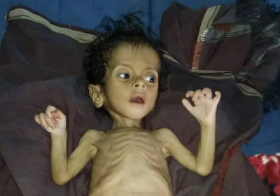 وفاة طفل بسبب سوء التغذية في المسيمير بلحج