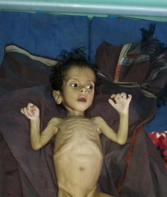 وفاة طفل بسبب سوء التغذية في المسيمير بلحج