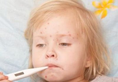  أمريكا: استمرار تفشي مرض الحصبة في ٢٢ ولاية منذ بداية العام