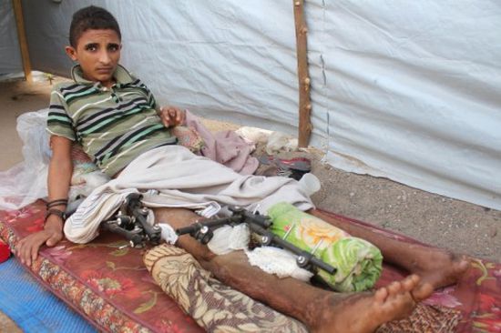 عبد الله..قصة مؤلمة لطفل يمني أعاقته ألغام المليشيات