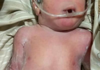 ولادة طفلة في مستشفى ردفان العام بعين واحدة وبدون أنف