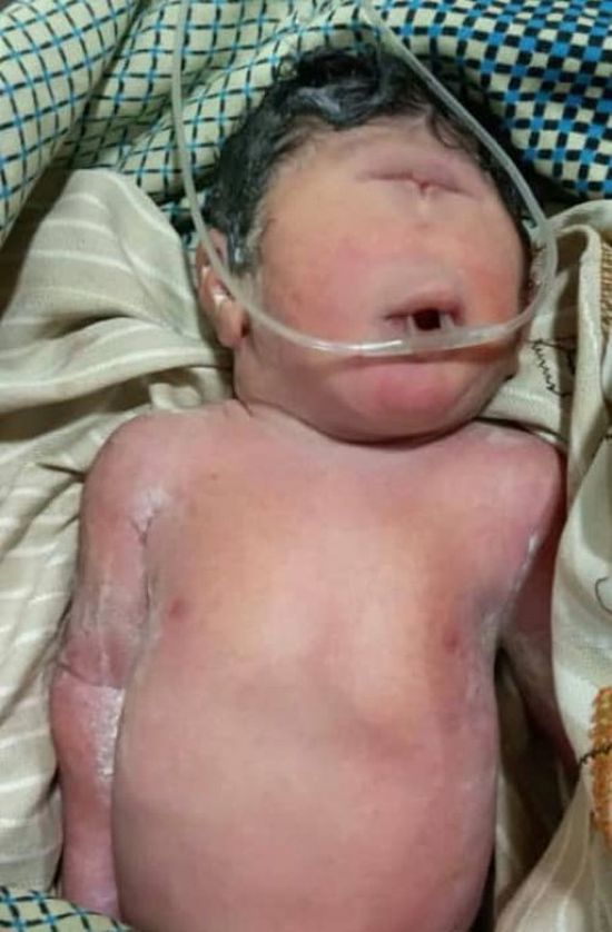 ولادة طفلة في مستشفى ردفان العام بعين واحدة وبدون أنف