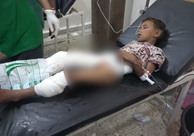 جريمة جديدة للمليشيات..بتر قدم طفل أصيب بقذيفة حوثية في التحيتا (فيديو)