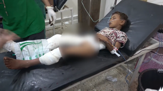 جريمة جديدة للمليشيات..بتر قدم طفل أصيب بقذيفة حوثية في التحيتا (فيديو)