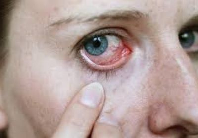 تحذيرات طبية من هربس العين..يسبب العمي