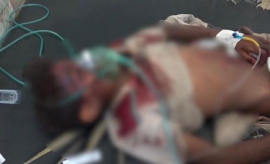 شهداء وجرحى أطفال من أسرة واحدة في قصف حوثي بالحديدة (فيديو)
