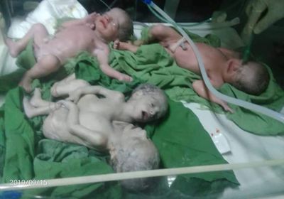 ولادة 4 توأم منهم 2 سيامي في أحد مستشفيات صنعاء 