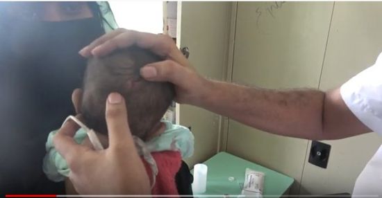 إصابة طفلين بقناصة مليشيا الحوثي في حيس بالحديدة (فيديو)