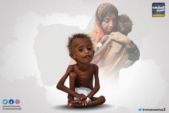 مليونا طفل يصارعون الموت في اليمن بسبب سوء التغذية (انفوجراف) 