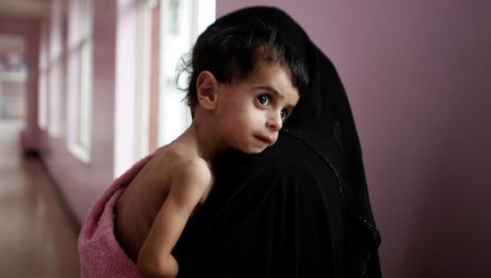 سوء التغذية.. "غول" الحوثي والشرعية الذي انتهك البطون الخاوية
