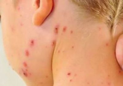 ساموا تعلن حالة الطوارئ وتغلق جميع المدارس بعد تفشي الحصبة