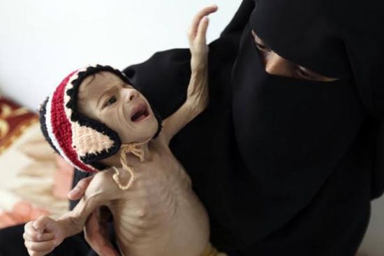 عدوان من الحوثي والشرعية.. "صورة الطفل" الذي حرّك البشر والحجر