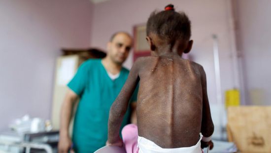  ضحايا البطش الحوثي.. "آمال دولية" تداعب مرضى صنعاء