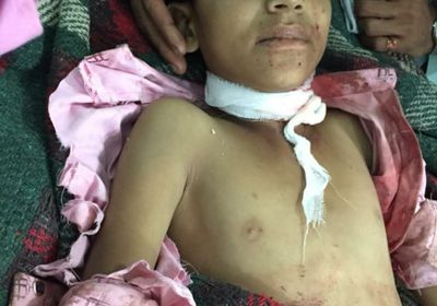 قذيفة حوثية تمزق طفلا في الضالع