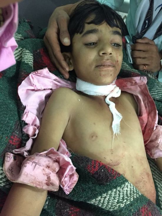 قذيفة حوثية تمزق طفلا في الضالع